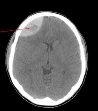 Treatment of subdural hematoma with steroids